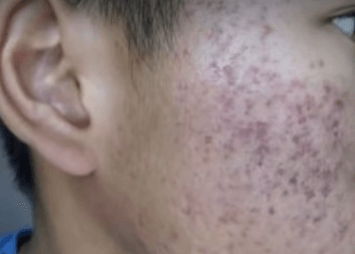 Post Inflammatory Erythemea red spots on face